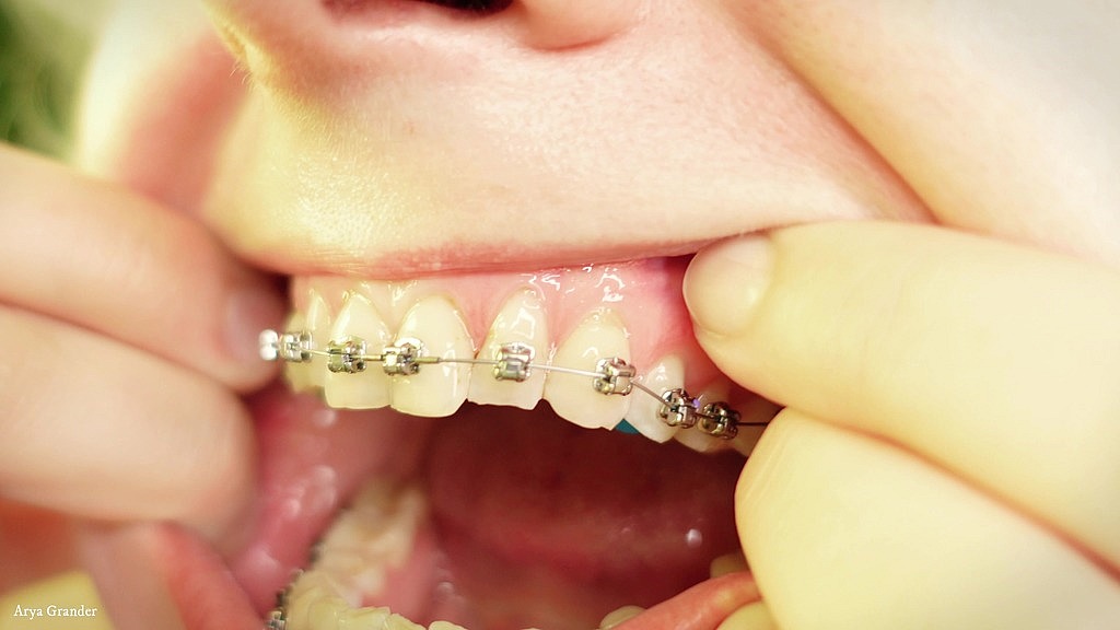 braces fetish - mouth tour close up (arya grander) (Arya Grander) braces fetish - mouth tour close up (arya grander) (Arya Grander)