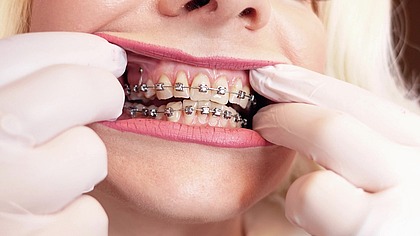 ASMR video: hot BRACES and double layer of medical nurse nitrile gloves