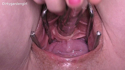Close Up Urethra & Cervix Prolapse