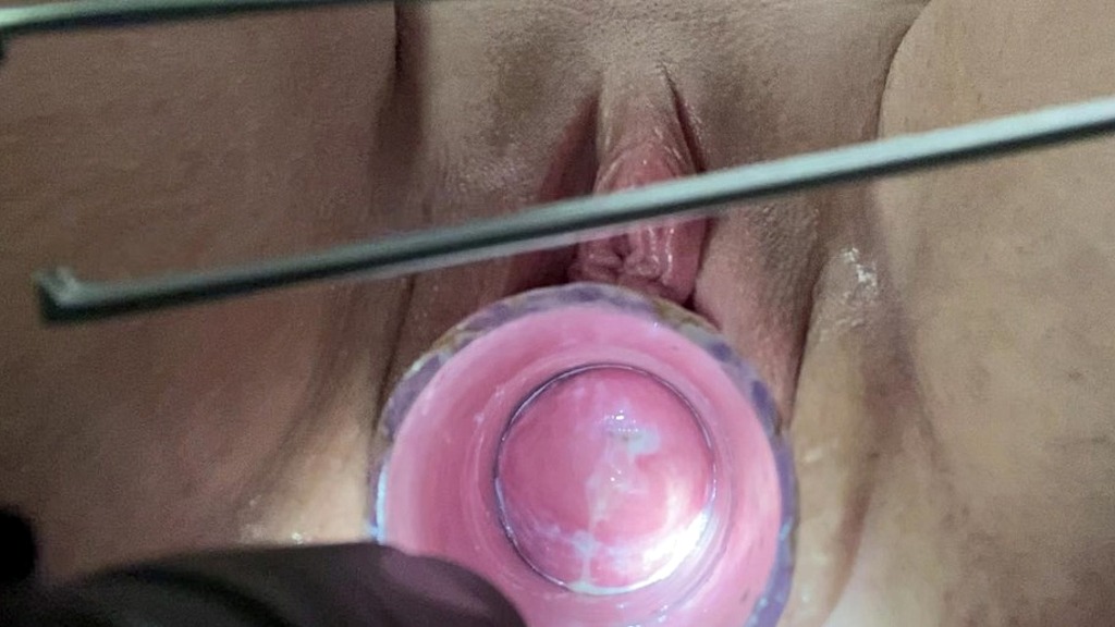 opening cervix with tweezer forceps (Electrasexual) opening cervix with tweezer forceps (Electrasexual)