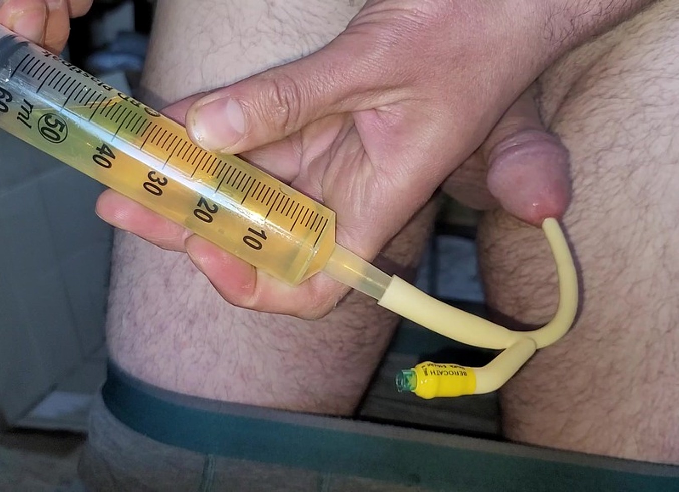 Inserting A Ch20 Catheter And Cum