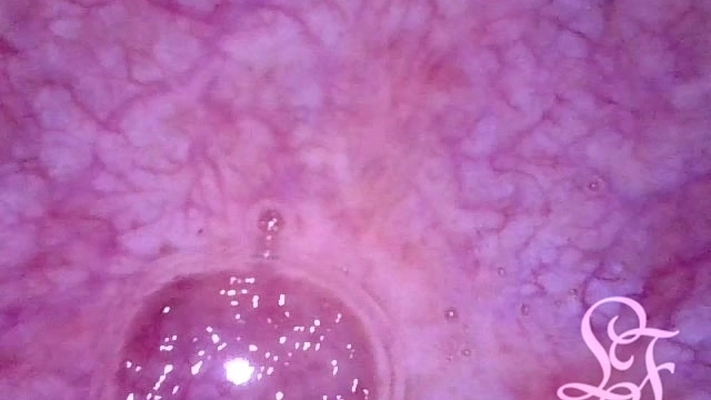pov endoscope catheter bladder inflation! (Lina Free) pov endoscope catheter bladder inflation! (Lina Free)