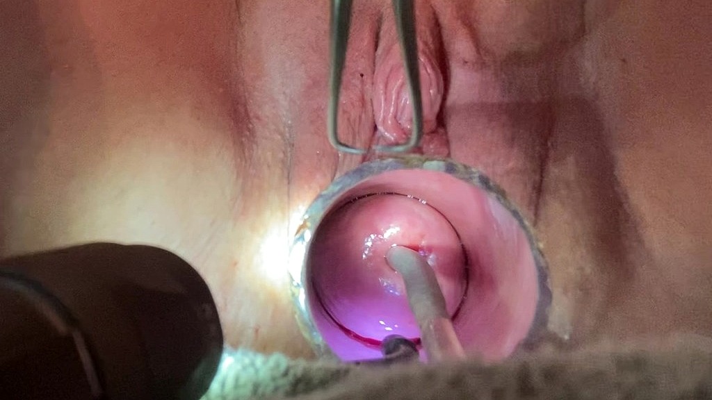 frozen sound penetrates cervix with tenaculum (Electrasexual) frozen sound penetrates cervix with tenaculum (Electrasexual)